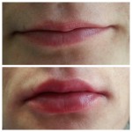 Hijaluronski fileri - korekcija usana pre i posle
